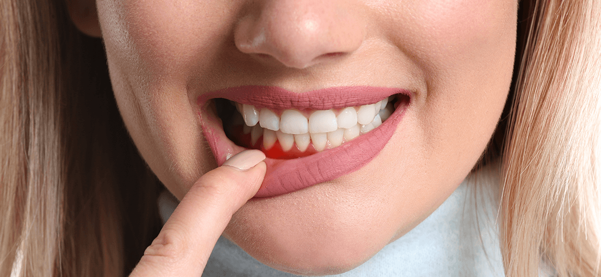 Gingivitis Belirtileri ve Tedavi Yöntemleri