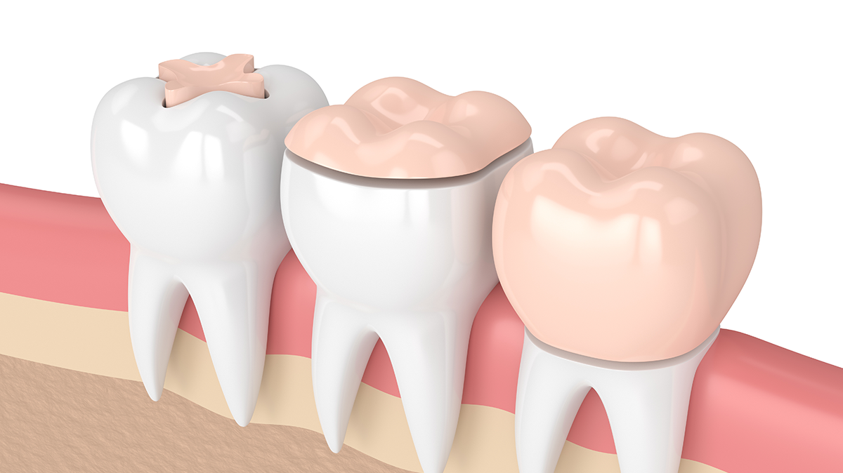 Inlay Onlay Kuronlar