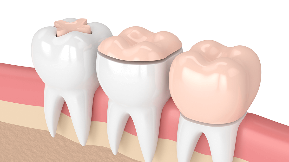 Inlays onlays Couronnes