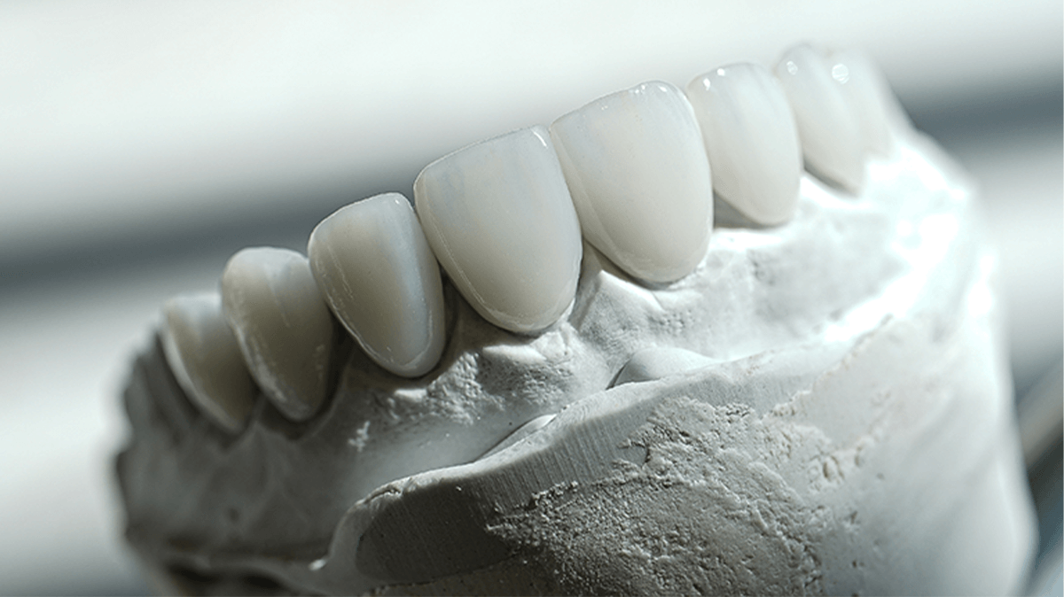 Laminate Veneer Tedavisi